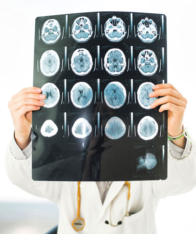 Gehirn Röntgen Demenz Schlaganfall